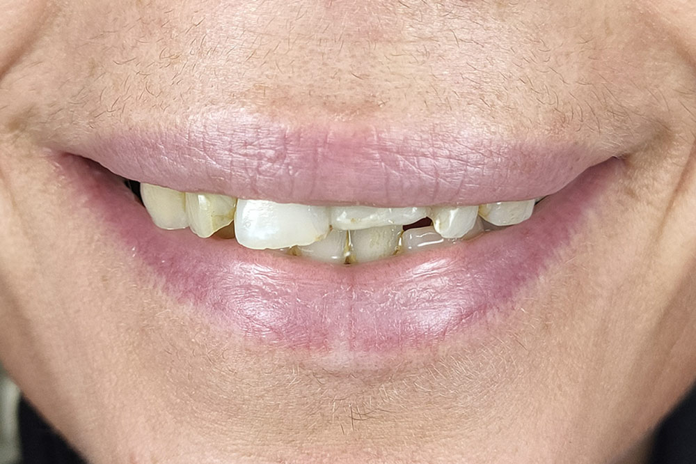 Caso 1 - Antes: Boca con dientes irregulares y alguno de ellos roto.