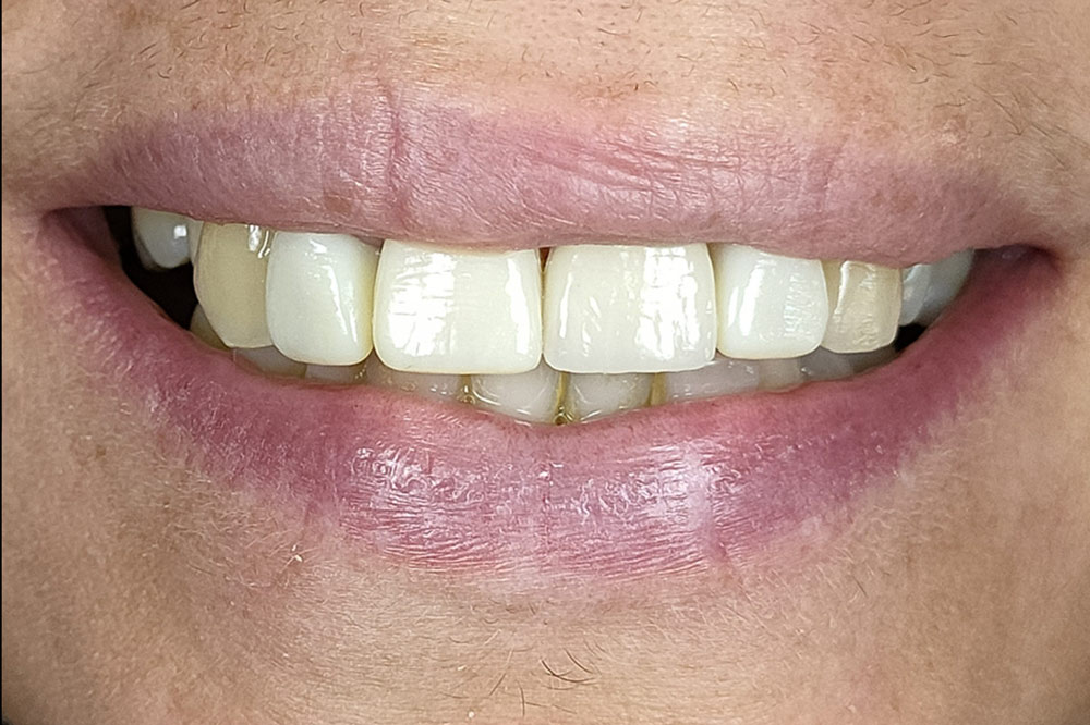 Caso 1 - Después: Boca con dientes alineados y bien dispuestos