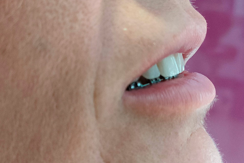 Labios de perfil, planos y sin apenas volumen.