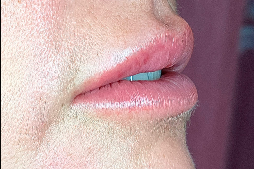 Labios de perfil, con silueta marcada y voluminosa
