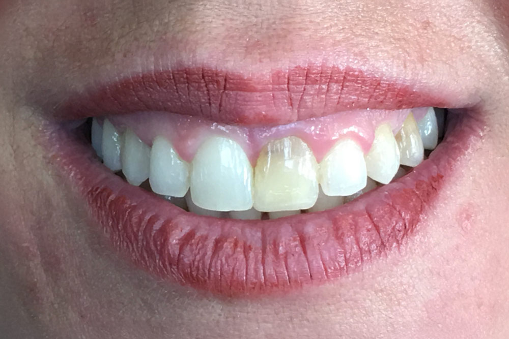 Caso 3 - Antes: Dientes de color amarillento