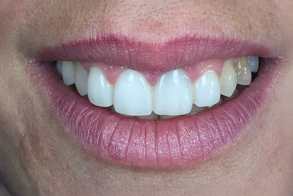 Caso 3 - Después: Dientes blancos y uniformes