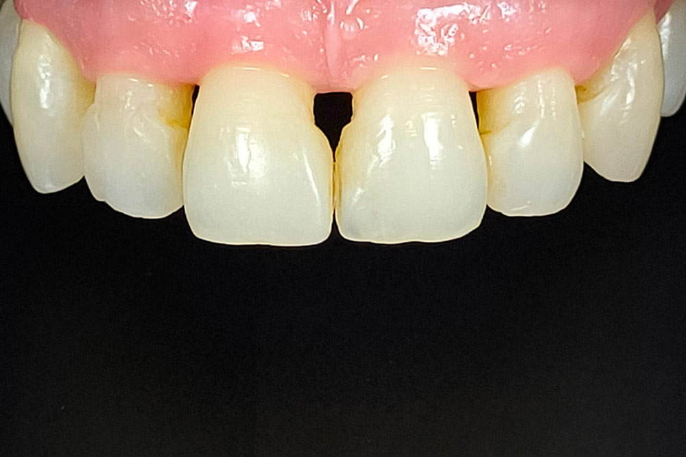 Caso 4 - antes: Dientes con encías deterioradas, con triángulos negros entre los dientes.