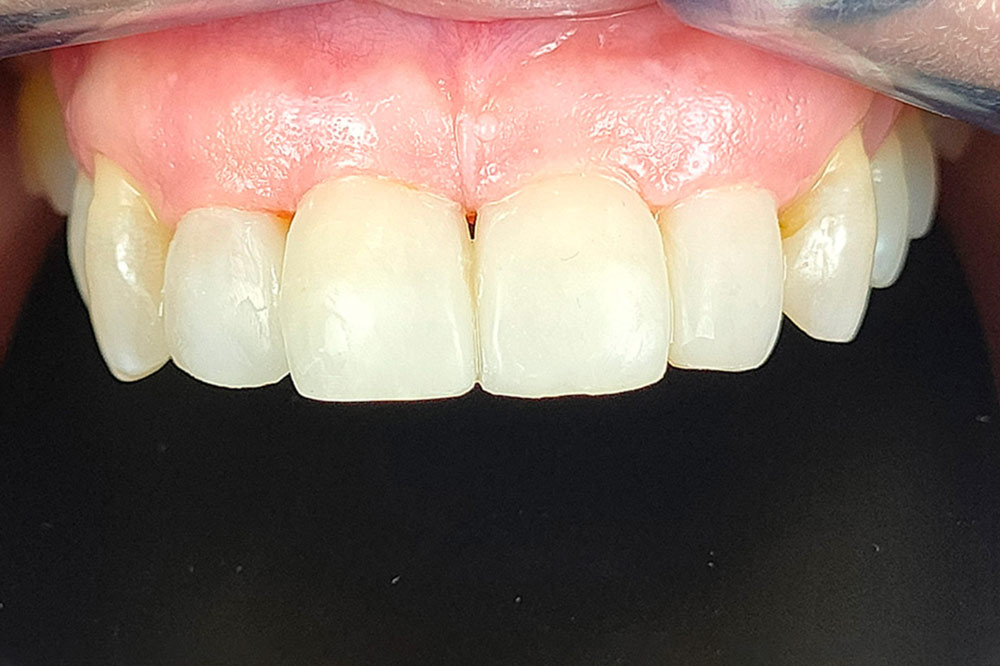 Caso 4 - Después: Dientes alineados y restauradas mediante carillas de composite