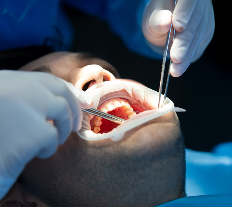 Dentista realizando una cirugía sobre una boca abierta, con instrumentos quirúrgicos.
