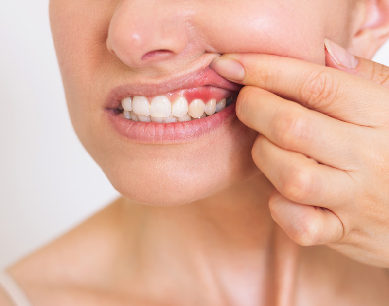 Mujer mostrando sus encías inflamadas, levantando con sus dedos el labio superior.