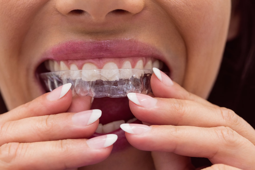 Primer plano de una boca de mujer que se está colocando su ortodoncia Invisalign