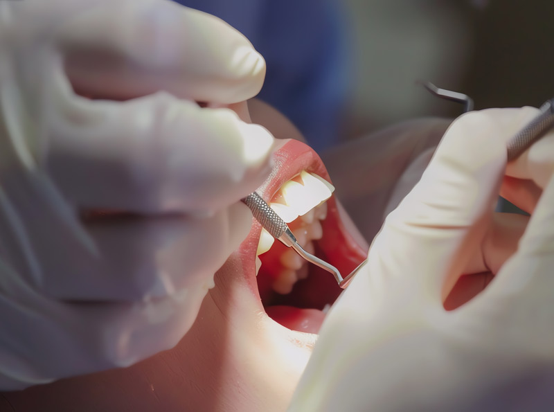 Vista lateral de una boca abierta en plena intervención quirúrgica